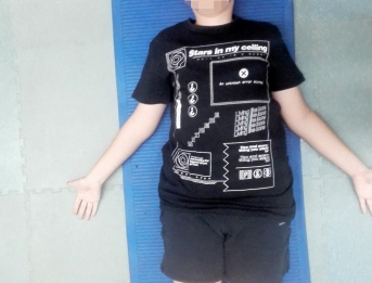Treball RPG (Readatació Postural Global) en Escoliosi
